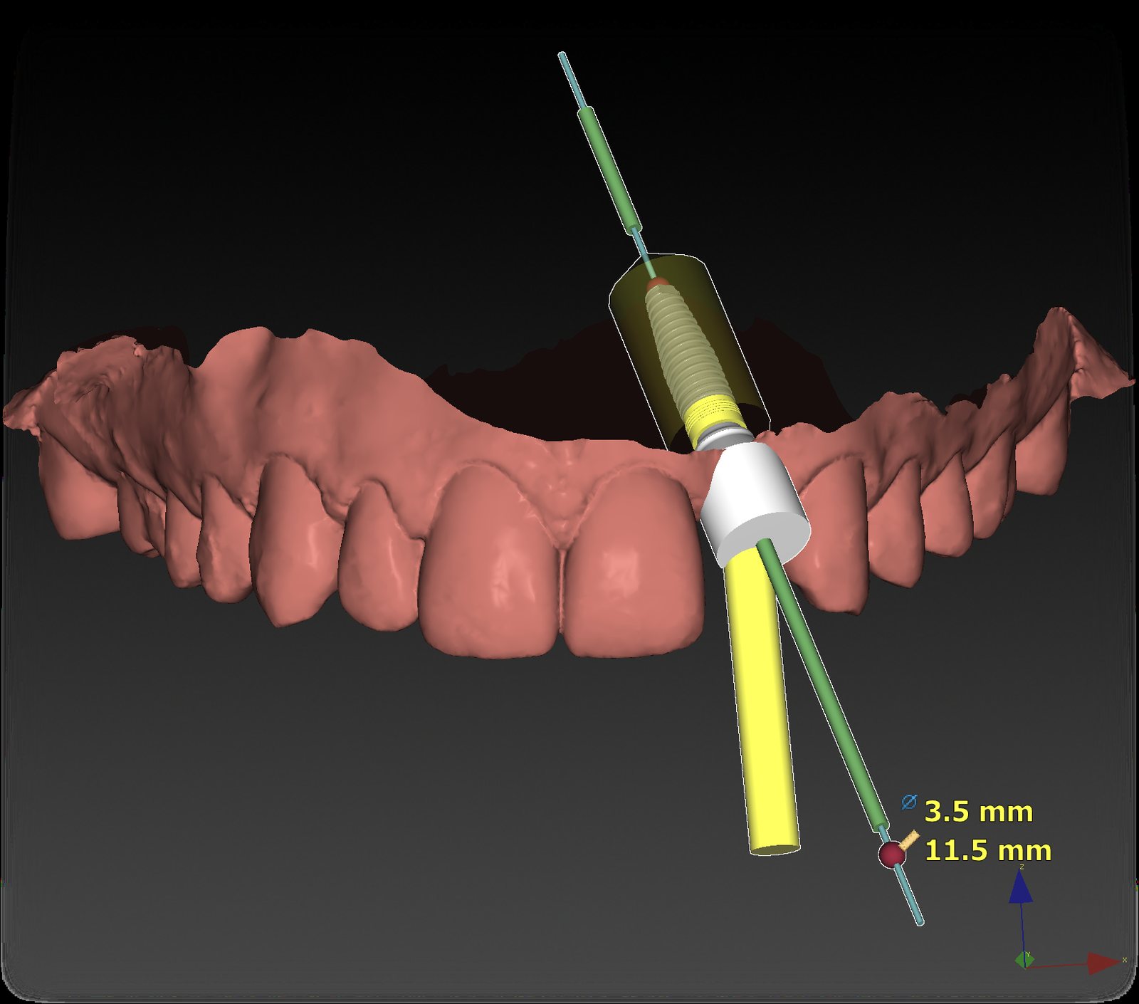 Dijital model üzerinde implant konumu ve açısının planlanması