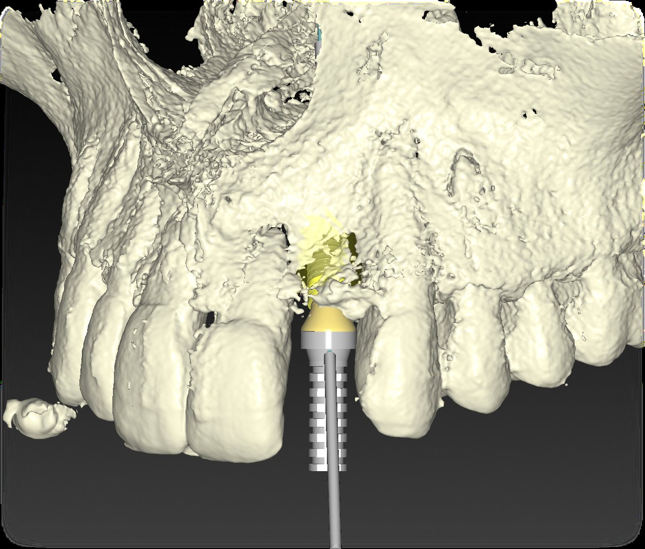 Tomografiden elde edilen üç boyutlu çene kemiği modeli üzerinde implant