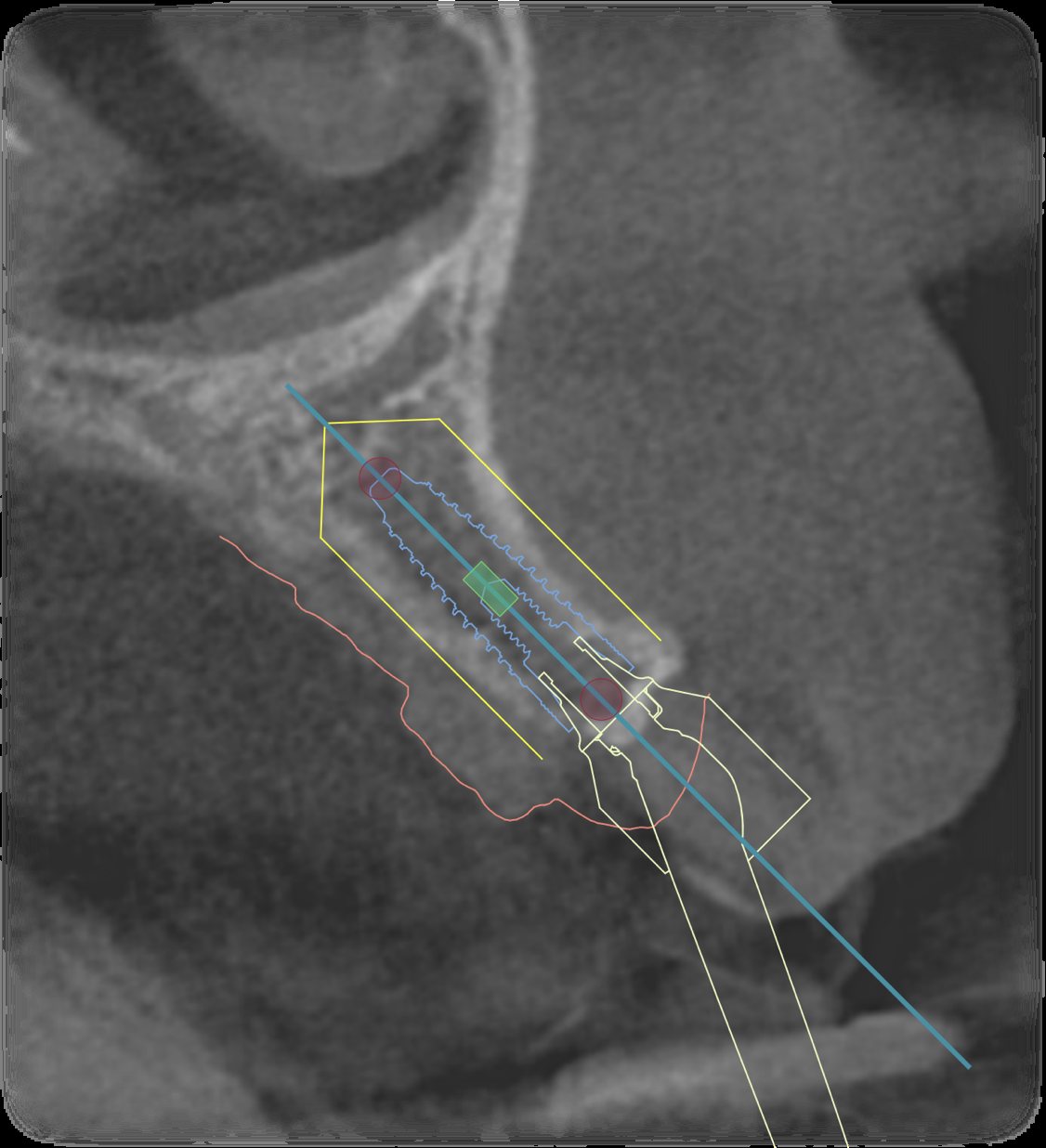 Üç boyutlu tomografi kesiti üzerinde implant planlaması